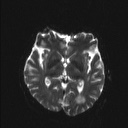 File:Balo concentric sclerosis (Radiopaedia 50458-55940 Axial DWI 12).jpg