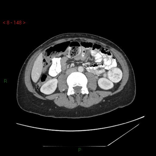 Bartholin gland cyst (Radiopaedia 54904-61181 A 37).jpg