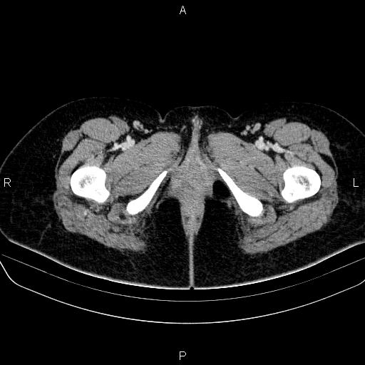 File:Bartholin gland cyst (Radiopaedia 62635-70930 Axial Post contrast 95).jpg