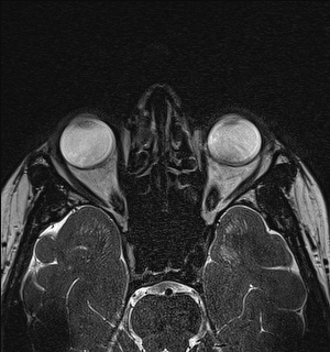 Basal cell carcinoma - nasal region (Radiopaedia 70292-80365 Axial Gradient Echo 72).jpg