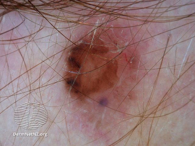 File:Basal cell carcinoma affecting the face (DermNet NZ lesions-bcc-face-1056).jpg