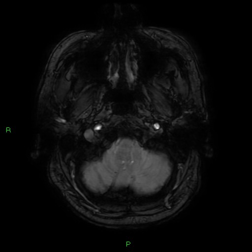 Basal ganglia hemorrhage (Radiopaedia 58346-65468 Axial SWI 6).jpg