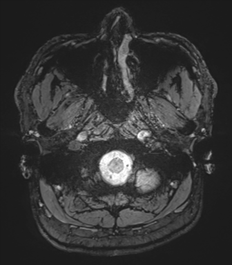 Basal ganglia hemorrhage - hypertensive (Radiopaedia 42227-45303 Axial SWI magnitude 2).png
