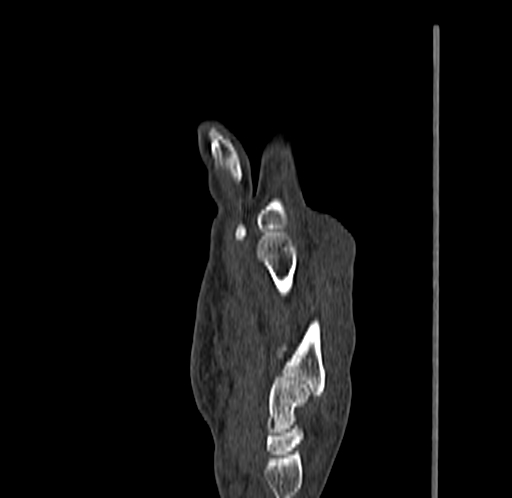 Base of 2nd metacarpal fracture (Radiopaedia 73741-84544 Sagittal bone window 45).jpg