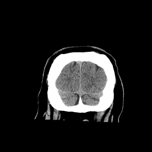 Basilar and bilateral vertebral artery occlusion (Radiopaedia 45592-49723 Coronal 59).png