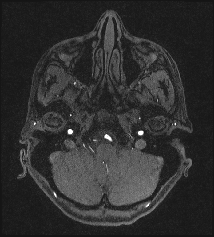 Basilar artery perforator aneurysm (Radiopaedia 82455-97733 Axial MRA 46).jpg