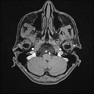 Basilar artery perforator aneurysm (Radiopaedia 82455-97733 Axial T1 fat sat 18).jpg