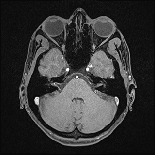 Basilar artery perforator aneurysm (Radiopaedia 82455-97733 Axial T1 fat sat 39).jpg