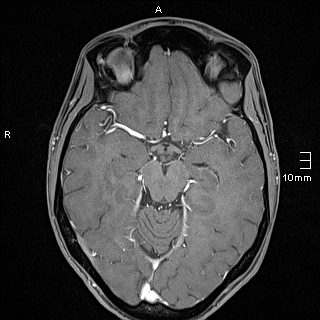 Basilar artery perforator aneurysm (Radiopaedia 82455-99523 G 59).jpg