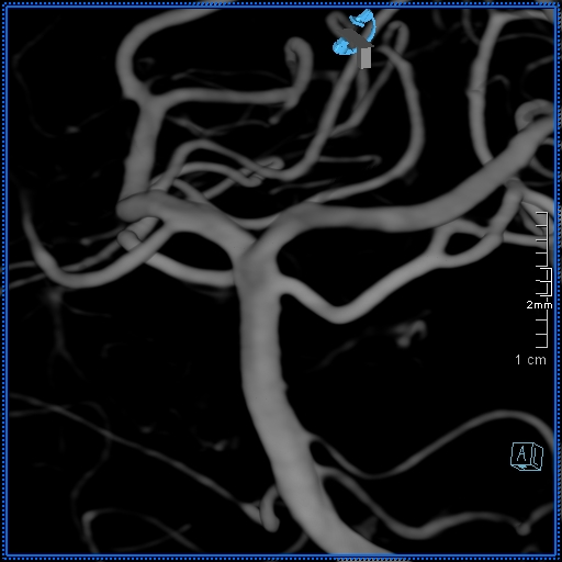 Basilar artery perforator aneurysm (Radiopaedia 82455-99524 3D Left VA 36).jpg