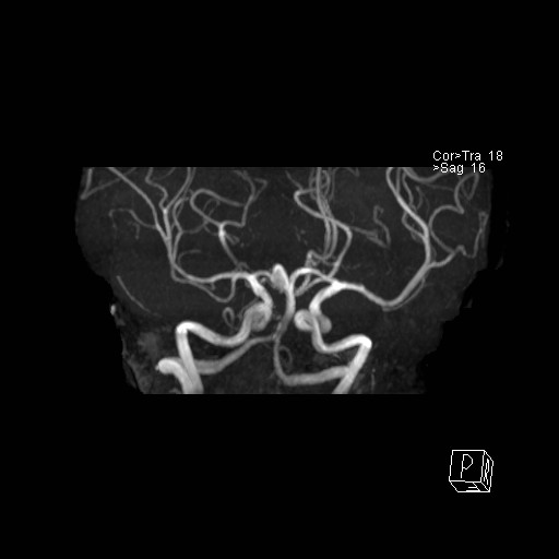 Basilar tip aneurysm (Radiopaedia 26504-26632 D 44).jpg