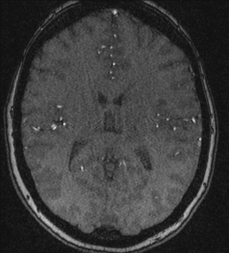 Basilar tip aneurysm (Radiopaedia 26504-26632 MRA 144).jpg