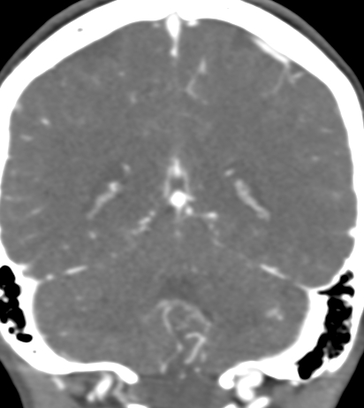 File:Basilar tip aneurysm with coiling (Radiopaedia 53912-60086 B 109).jpg