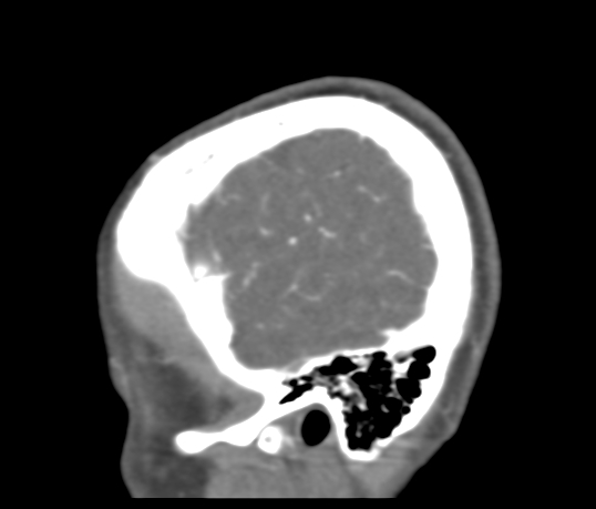 Basilar tip aneurysm with coiling (Radiopaedia 53912-60086 C 123).jpg