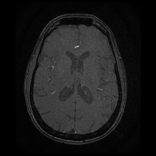 Basilar top and left middle cerebral artery aneurysm (Radiopaedia 61965-70031 Axial MRA 99).jpg