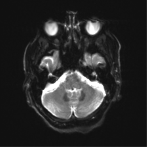 Behavioral variant frontotemporal dementia and late onset schizophrenia (Radiopaedia 52197-58083 Axial DTI Trace W 6).png