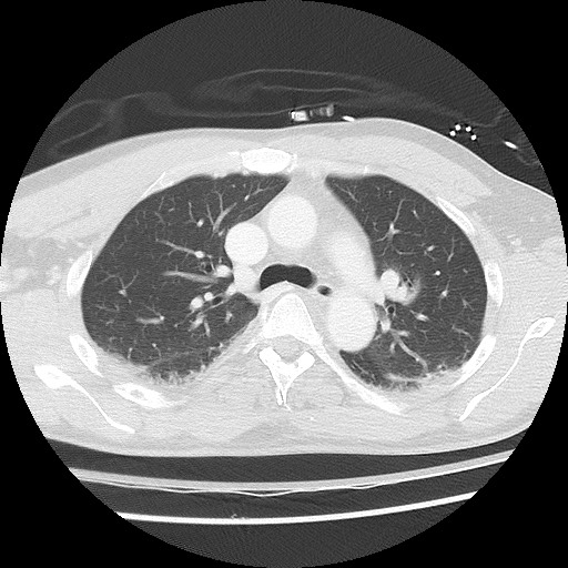 Benign post-traumatic pseudopneumoperitoneum (Radiopaedia 71199-81495 Axial lung window 30).jpg