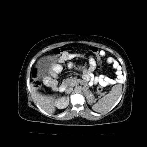 Benign spindle cell tumor - abdominopelvic (Radiopaedia 61300-69212 Axial C+ delayed 18).jpg
