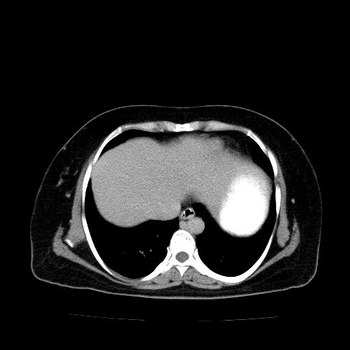 Benign spindle cell tumor - abdominopelvic (Radiopaedia 61300-69212 Axial C+ delayed 7).jpg