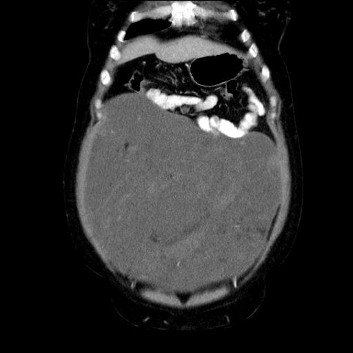 File:Benign spindle cell tumor - abdominopelvic (Radiopaedia 61300-69212 C 15).jpg