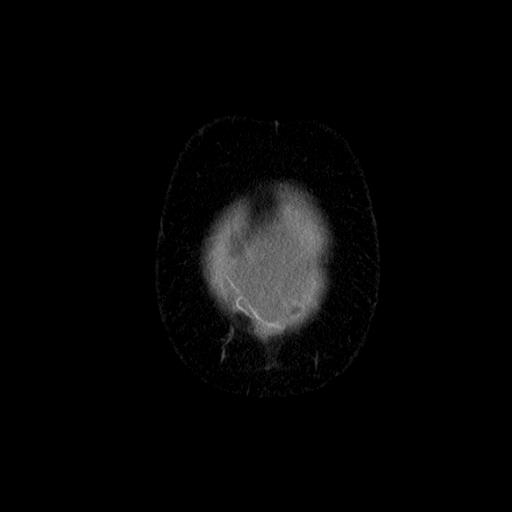 File:Benign spindle cell tumor - abdominopelvic (Radiopaedia 61300-69212 C 4).jpg