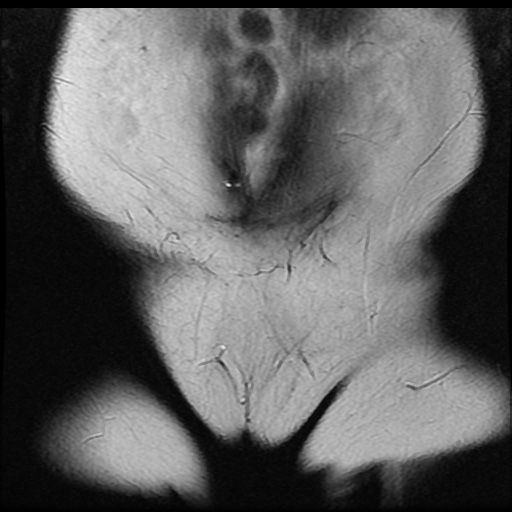File:Bicornuate uterus (Radiopaedia 51676-57472 Coronal T2 3).jpg