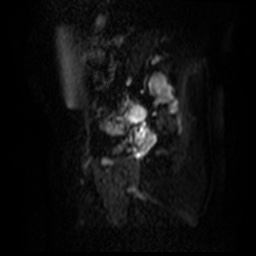 File:Bicornuate uterus (Radiopaedia 51676-57472 Sagittal DWI 19).jpg