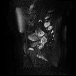 File:Bicornuate uterus (Radiopaedia 51676-57472 Sagittal DWI 43).jpg