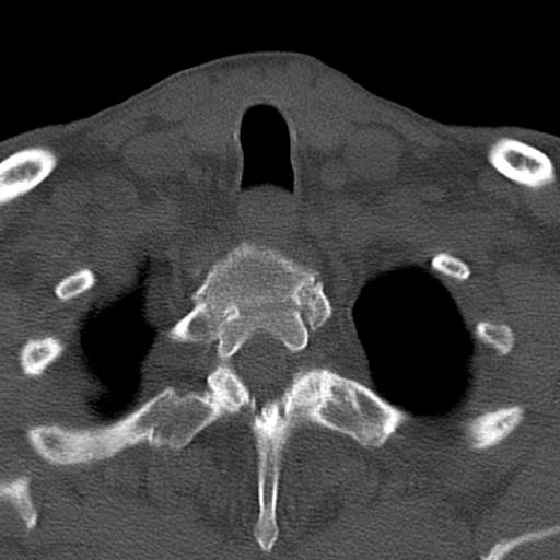 File:Bilateral C6-7 locked facet dislocation (Radiopaedia 28506-28748 Axial bone window 41).jpeg