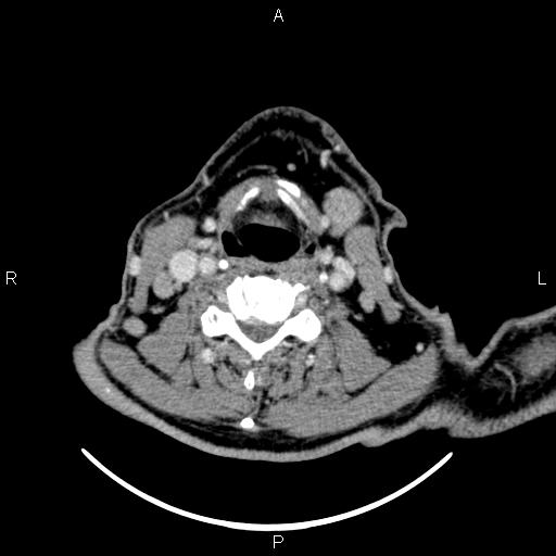 Bilateral Warthin tumors (Radiopaedia 84034-99263 Axial With contrast 41).jpg