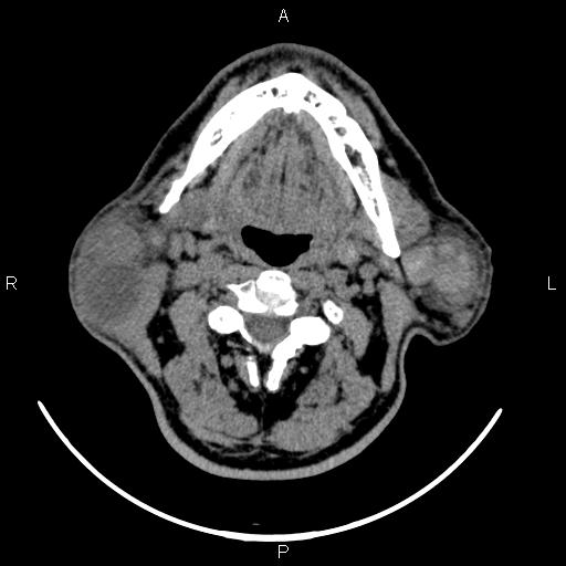 Bilateral Warthin tumors (Radiopaedia 84034-99263 Axial non-contrast 28).jpg