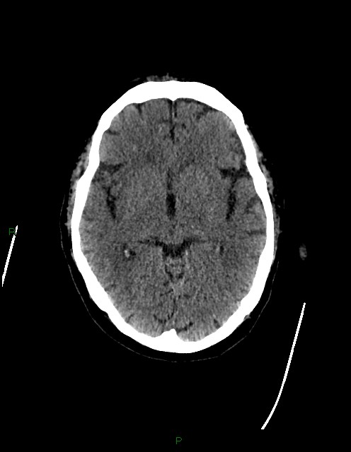 Bilateral acute middle cerebral artery territory infarcts (Radiopaedia 77319-89401 Axial non-contrast 39).jpg