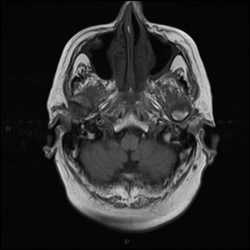 File:Bilateral acute middle cerebral artery territory infarcts (Radiopaedia 77319-89402 Axial T1 4).jpg
