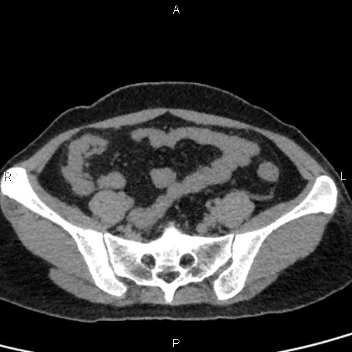 Bilateral adrenal gland hyperenhancement in pancreatitis (Radiopaedia 86642-102753 Axial non-contrast 86).jpg