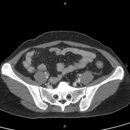 Bilateral adrenal gland hyperenhancement in pancreatitis (Radiopaedia 86642-102753 E 86).jpg