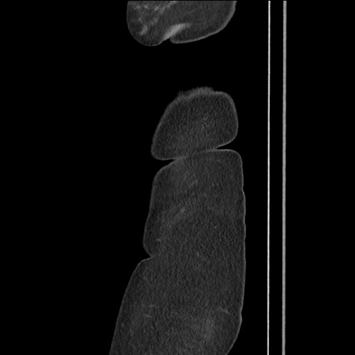 File:Bilateral adrenal granulocytic sarcomas (chloromas) (Radiopaedia 78375-91007 C 15).jpg