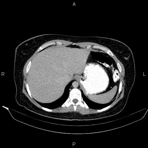 Bilateral adrenal myelolipoma (Radiopaedia 63058-71535 Axial C+ delayed 1).jpg
