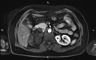Bilateral adrenal myelolipoma (Radiopaedia 63058-71537 Axial T1 C+ fat sat 41).jpg
