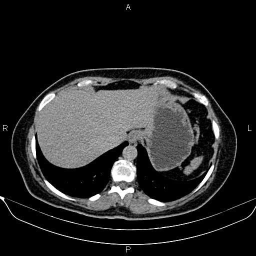 File:Bilateral benign adrenal adenomas (Radiopaedia 86912-103124 Axial C+ delayed 5).jpg