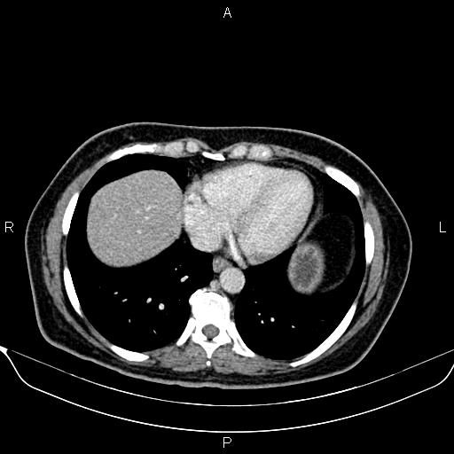 Bilateral benign adrenal adenomas (Radiopaedia 86912-103124 B 11).jpg