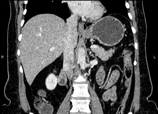 Bilateral benign adrenal adenomas (Radiopaedia 86912-103124 D 32).jpg
