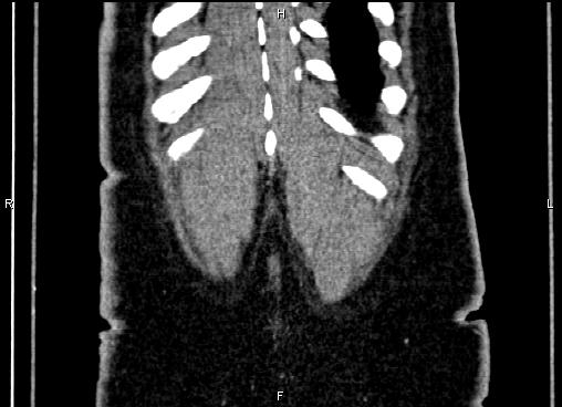 Bilateral benign adrenal adenomas (Radiopaedia 86912-103124 D 63).jpg
