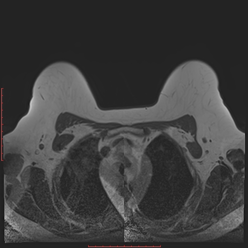 File:Bilateral breast implant rupture (Radiopaedia 24761-25027 T1 7).jpg