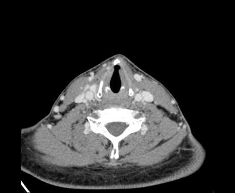 Bilateral carotid body tumors (Radiopaedia 61841-69870 Axial Post contrast 76).jpg