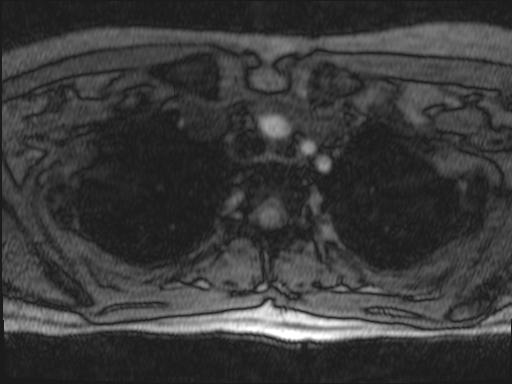 Bilateral carotid body tumors and right glomus jugulare tumor (Radiopaedia 20024-20060 Axial MRA 168).jpg