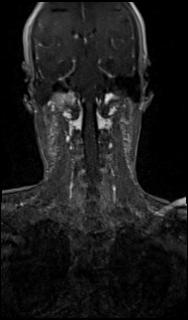 File:Bilateral carotid body tumors and right glomus jugulare tumor (Radiopaedia 20024-20060 MRA 49).jpg