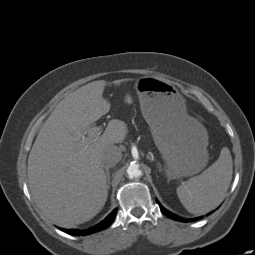 Bilateral delayed nephrogram from renal artery stenosis (Radiopaedia 47681-52362 A 15).png