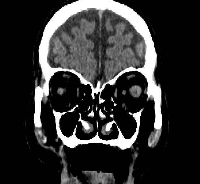 Bilateral ectopia lentis (Radiopaedia 89889-107013 Coronal non-contrast 55).jpg