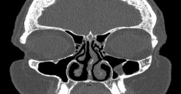 File:Bilateral ectopic infraorbital nerves (Radiopaedia 49006-54084 Coronal 49).png