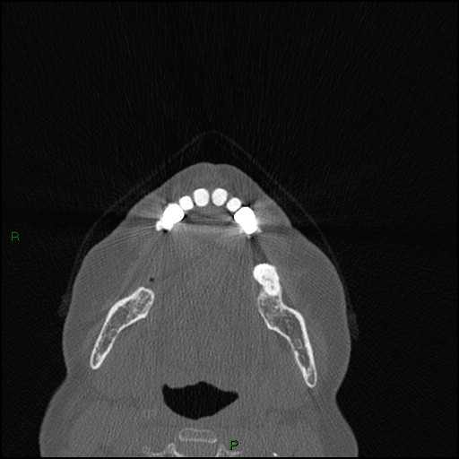 File:Bilateral frontal mucoceles (Radiopaedia 82352-96454 Axial bone window 285).jpg